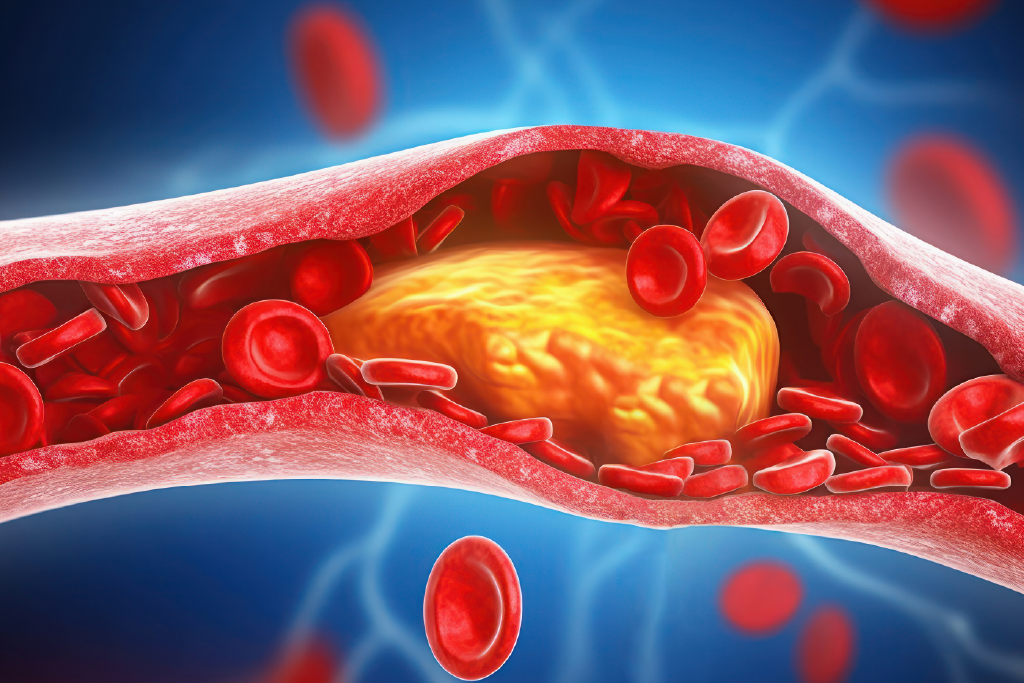 high-cholesterol-levels-in-the-blood