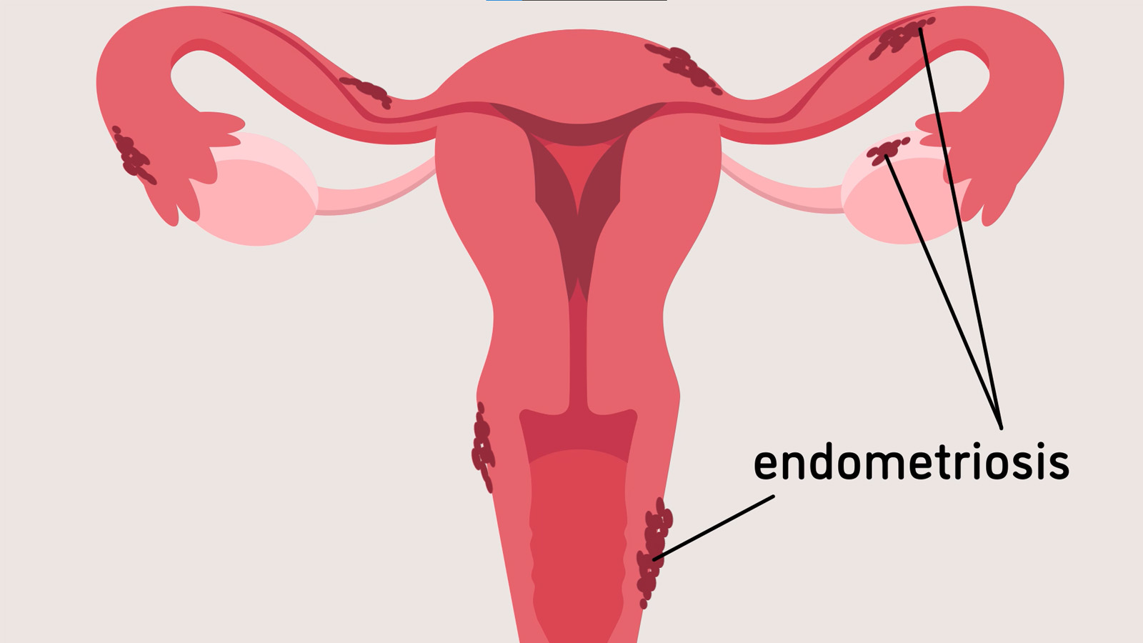 nutrition-for-endometriosis-a-guide-to-manage-symptoms