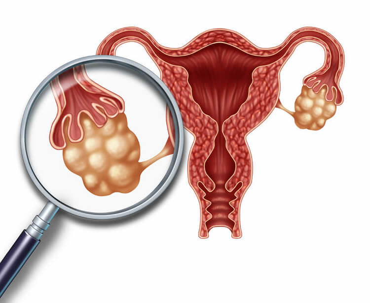 what-is-polycystic-ovary-syndrome-pcos